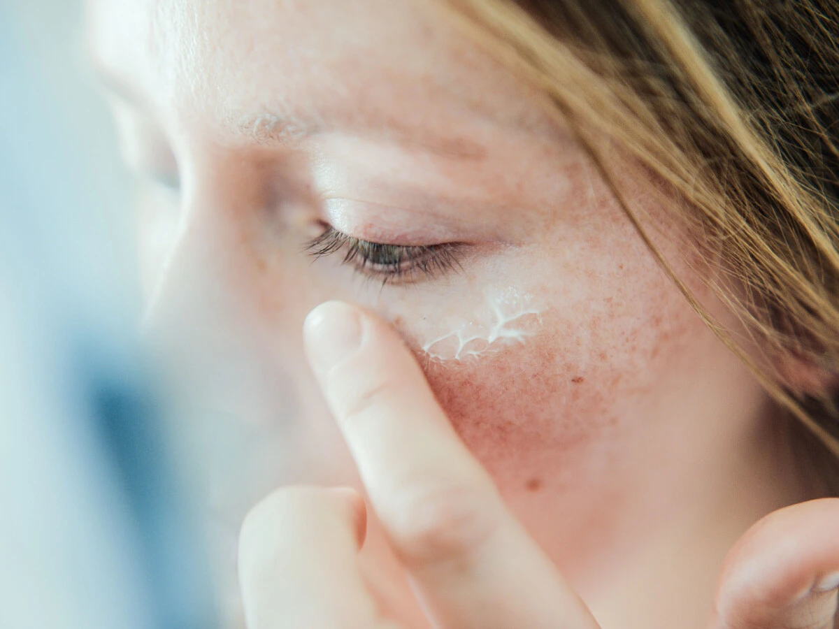  Frau trägt Pflege im Gesicht nach Sonnenbrand auf 