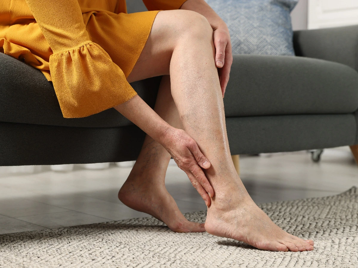  Frau mit Krampfadern 